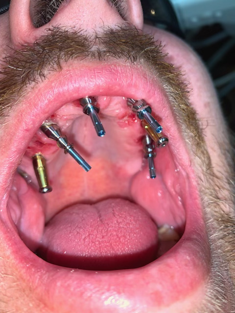 Dental Implants